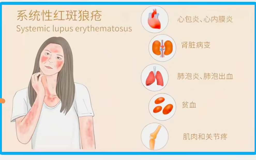 为什么这么年轻会得红斑狼疮？