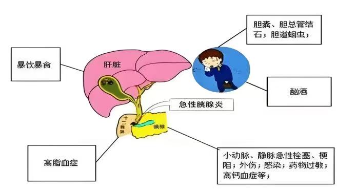重症胰腺炎的健康宣教